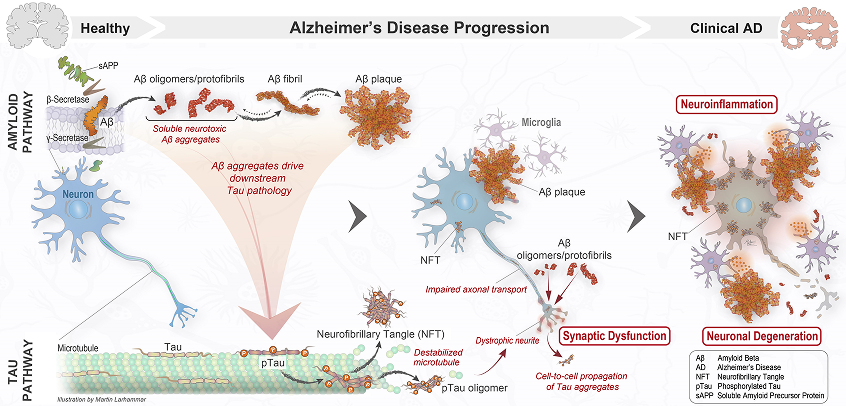Patologin bakom Alzheimers sjukdom