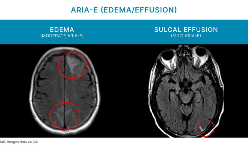 ARIA - E