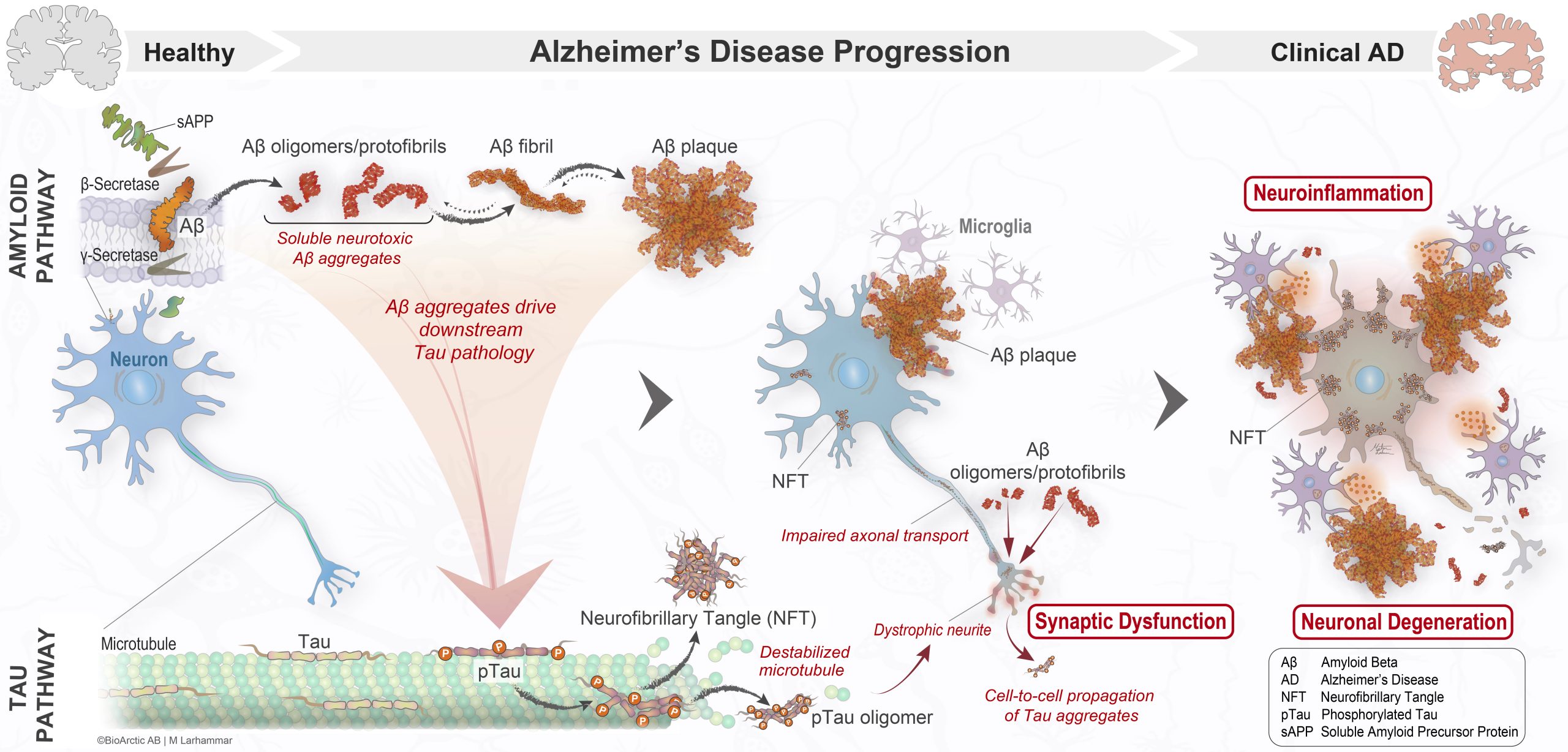 Patologin bakom Alzheimers sjukdom